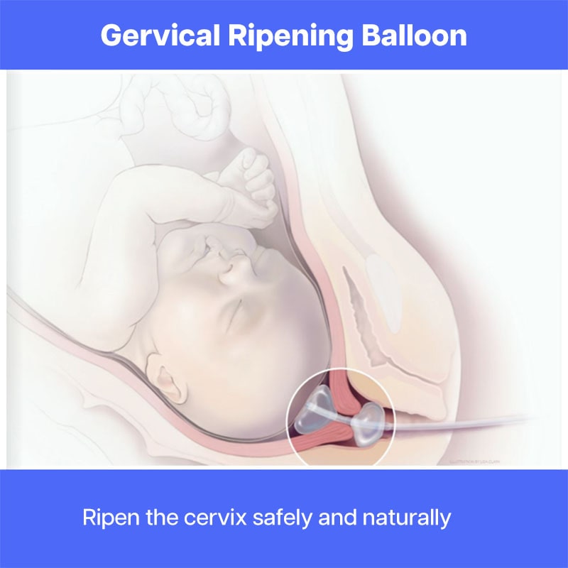Dual-lumen Cervical Ripening Balloon